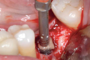 Read more about the article Remoção de implante dentário osseointegrado mal posicionado e implantação imediata associada à enxertia óssea