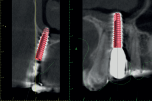 Read more about the article Aplicação do fluxo de cirurgia guiada para acessar o parafuso do pilar protético em próteses cimentadas