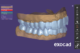 DentalCAD 3.2 Elefsina: conheça os novos recursos do Bite Splint Module