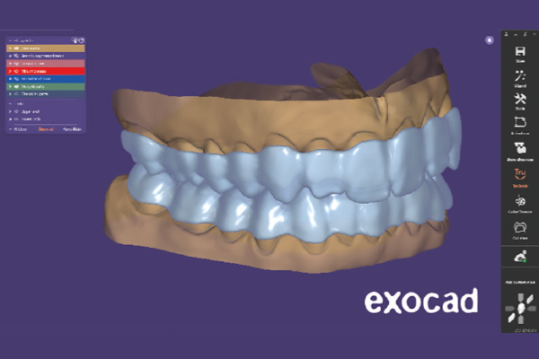 You are currently viewing DentalCAD 3.2 Elefsina: conheça os novos recursos do Bite Splint Module