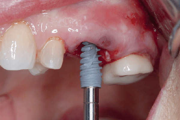 You are currently viewing Osseodensificação: uma adição valiosa na instalação de implantes imediatos