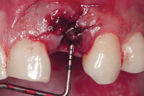 You are currently viewing Interferência da condição pulpar de dentes vizinhos em cirurgias de reconstrução óssea