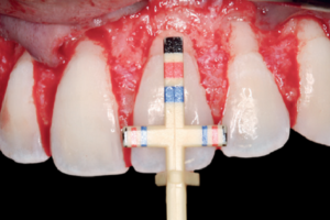 Read more about the article Harmonização cirúrgica da assimetria periodontal em paciente com sorriso gengival decorrente de erupção passiva alterada