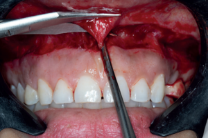 Read more about the article Cirurgia de reposicionamento labial para correção do sorriso gengival por meio da “muscle detachment technique”: uma nova abordagem cirúrgica