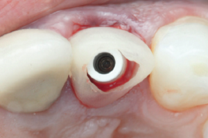 Read more about the article Implante dentário imediato na zona estética associado à técnica de retenção intencional do fragmento radicular: relato de caso clínico com 18 meses de acompanhamento