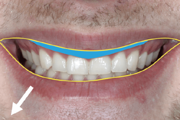 You are currently viewing Diagnóstico labial: foco nas disfunções periorais, assimetrias e lábio duplo