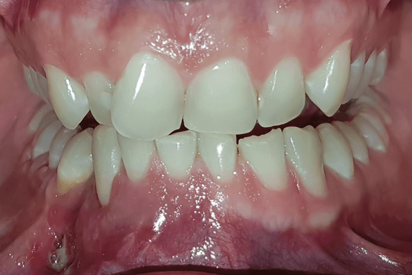 Read more about the article Planejamento digital para instalação de implantes dentários após reconstrução mandibular: um relato de caso