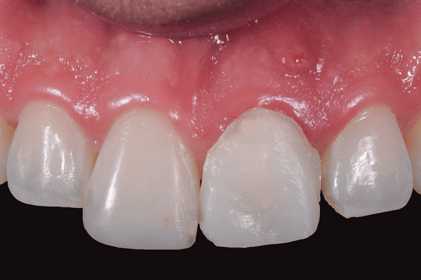 Read more about the article Reabilitação estética em dentes anteriores com implantes osseointegrados: desafio clínico