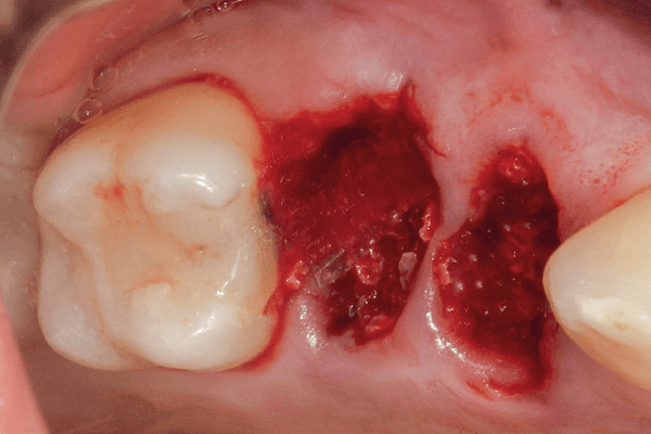 Read more about the article Uso de membranas de ácido polilático e poliglicólico no tratamento de alvéolos pós-exodontia com a tábua óssea vestibular comprometida – apresentação de três casos clínicos
