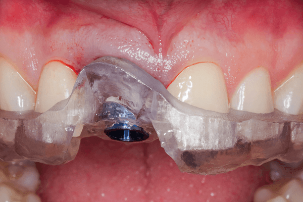 Read more about the article Uso de implante dentário imediato em região estética devido à fratura radicular e lesão periapical – relato de caso com oito meses de acompanhamento
