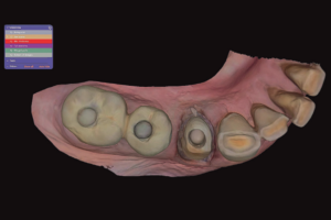 Read more about the article Reabilitação conservadora de dentes com tratamento endodôntico: o efeito endocrown